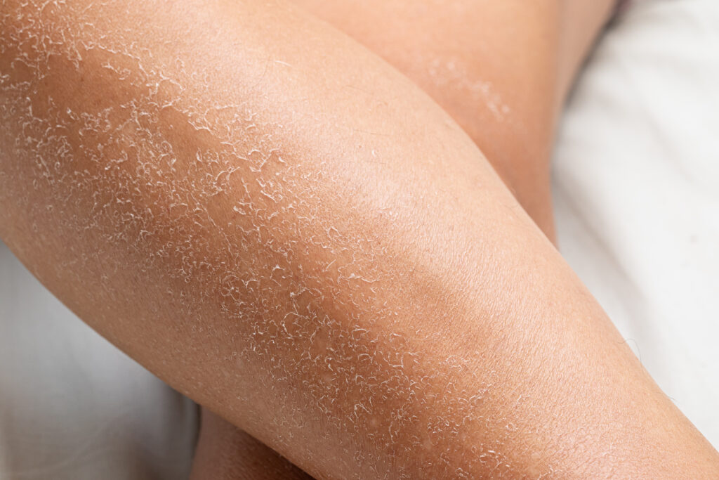 Comment enlever la peau de crocodile sur les jambes ?