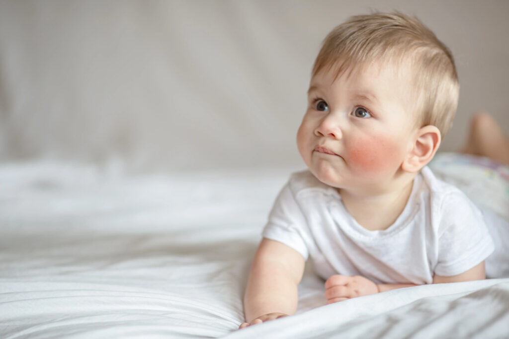 Comment prendre soin de bébé avec une peau atopique ?